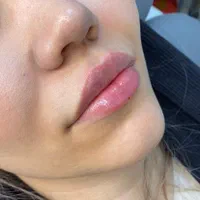 ژل لب متود روسی توسط پزشک حرفه ای|خدمات آرایشگری و زیبایی|حمیدیا, |دیوار