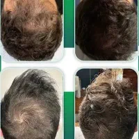مزوژل جوانساز پوستتو جوان کن prp۹۸۰|خدمات زیبایی و سلامت|اصفهان, بهار آزادی|دیوار