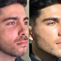 جشنواره تزریق ژل بوتاکس پکیج کانتورینگ لیفت ابرونخ|خدمات آرایشگری و زیبایی|تهران, اباذر|دیوار