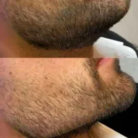 ژل و بوتاکس|خدمات آرایشگری و زیبایی|دورود, |دیوار