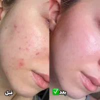 پاکسازی پوست تخفیف یلدا تضمینی|خدمات آرایشگری و زیبایی|ارومیه, |دیوار