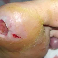 درمان زخمهای دیابتی،زخم بستر،سوختگی