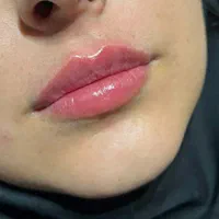 تزریق ژل بوتاکس وانزیم فیلر بینی ۳۹۹|خدمات آرایشگری و زیبایی|تهران, عبدل‌آباد|دیوار