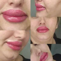 خدمات ژل بوتاکس میکرو قیمت استثنایی