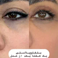 تخفیف ساکشن شکم پهلو و پشت/ هر ناحیه از بدن/بلفارو|خدمات آرایشگری و زیبایی|قم, زنبیل آباد|دیوار