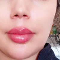 ژل بوتاکس مزو|خدمات آرایشگری و زیبایی|صدرا-فارس, فاز ۱|دیوار