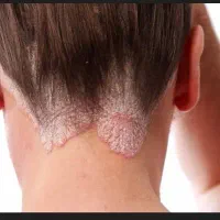 اگزما و پسوریازیس