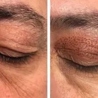 دستگاه پلکسر بدون بخیه|آرایشی، بهداشتی، درمانی|محمودآباد, |دیوار