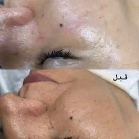 پاکسازی صورت ۲۵۰ تومن|خدمات آرایشگری و زیبایی|لاهیجان, کوی استادان|دیوار