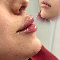 ژل، فیلر و بوتاکس با تخفیف ویژه