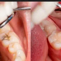 عصب کشی دندان های مولر (کرسی)|خدمات آرایشگری و زیبایی|بیرجند, |دیوار