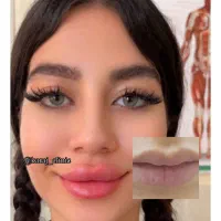 کلینیک ژل لب،فیلرزیرچشم،شقیقه،  بوتاکس فیلربادی