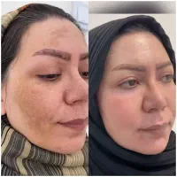 آخرین درمان ضد لک