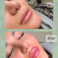 تخفیفات 40درصدی بوتاکس وژل دکتر کاظمی