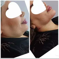 ساکشن غبغب تزریق چربی پی ارپی