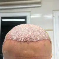 کاشت مو و‌ ابرو در کلینیک تخصصی با شرایط اقساطی