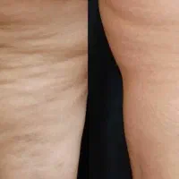 کویتیشن + آر اف/لاغری، کاهش سایز،لیفت‌ورفع سلولیت