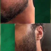 تونیک مجدد رشد مو