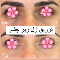 ژل بوتاکس|خدمات آرایشگری و زیبایی|قم, بکایی|دیوار