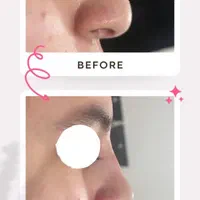 بلفاروپلاستی و رفع پف چشم ، لیفت شقیقه .جراح متخصص|خدمات آرایشگری و زیبایی|اردبیل, |دیوار