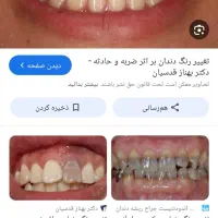 راهنمایی میخاستم/دندان