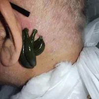 حجامت مرکزی اصفهان،زالو‌ درمانی میگرن واریس فصدprp|خدمات آرایشگری و زیبایی|اصفهان, مسجد مصلی|دیوار