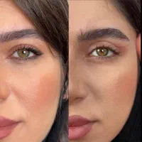 بلفاروپلاستی با روش چشم گربه ای