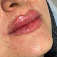 جوان سازی صورت بوتاکس مزو. فیلر