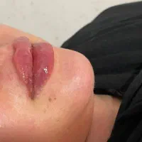 اف ویژه تزریق ژل و بوتاکس