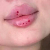 تزریق ژل و بوتاکس
