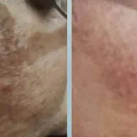 کرم روشن سازی و از بین برنده ی لکو جای جوش|آرایشی، بهداشتی، درمانی|چهارباغ, |دیوار