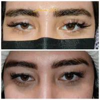 بلفاروپلاستی جراحی پلک لیفت شقیقه ابرو صورت بوتاکس|خدمات آرایشگری و زیبایی|تهران, سلسبیل جنوبی|دیوار