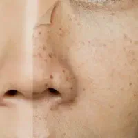 لک و کک و مک هاتو از بین ببر