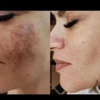 مزوندلینگ ،میکرونیلدینگ و درمان تخصصی لک