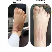 ترمیم زخم سوختگی|آرایشی، بهداشتی، درمانی|قم, حنیف نژاد|دیوار