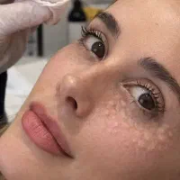مزوتراپی مزوژل جوانساز نخ لیفت توسط پزشک