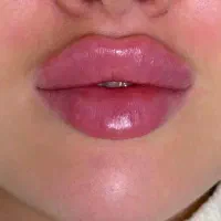 نیازمند مدل برای ژل و بوتاکس و مزو