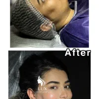 ساکشن غبغب با تکنیک وی لاین /صورت زاویه دار|خدمات زیبایی و سلامت|تهران, آرژانتین|دیوار