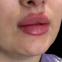 جشنواره تزریق ژل و بوتاکس و لیفت نخ و مزو چربی سوز|خدمات آرایشگری و زیبایی|کرمانشاه, |دیوار