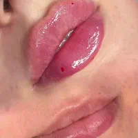 خدمات تزریق فیلر و بوتاکس