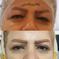 پزشک مسلط به جراحی بلفاروپلاستی