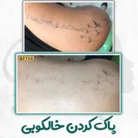پاک کردن تتو ابرو و ریموو خالکوبی بدن توسط پزشک|خدمات آرایشگری و زیبایی|رشت, گلسار|دیوار