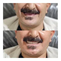 دندان مصنوعی،دندانسازی،دندان سازی،اقساطی،دندان|خدمات آرایشگری و زیبایی|مشهد, ایثارگران|دیوار
