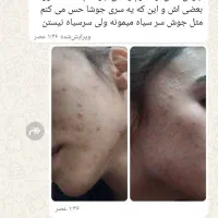 سرم گیاهی ضدجوش و لک