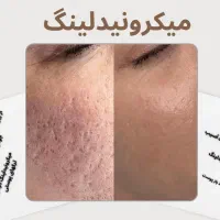 میکرونیدلینگ مزونیدلینگ مزوتراپی در منزل|خدمات آرایشگری و زیبایی|تهران, اختیاریه|دیوار