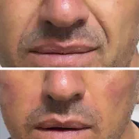 ژل بوتاکس تخفیف ویژه از ۲۸۰به بالا