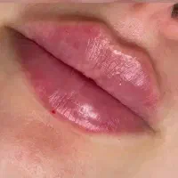 ژل و بوتاکس