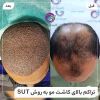 کاشت مو با متد روز بین الملل