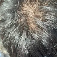 ریزش مو دارم پسر 18ساله هستم