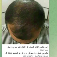 رویش مجدد مو|آرایشی، بهداشتی، درمانی|کوهدشت, |دیوار